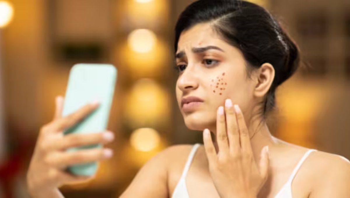 Adult Acne: किशोरावस्था तक सीमित नहीं, जानें वजह और सच्चाई