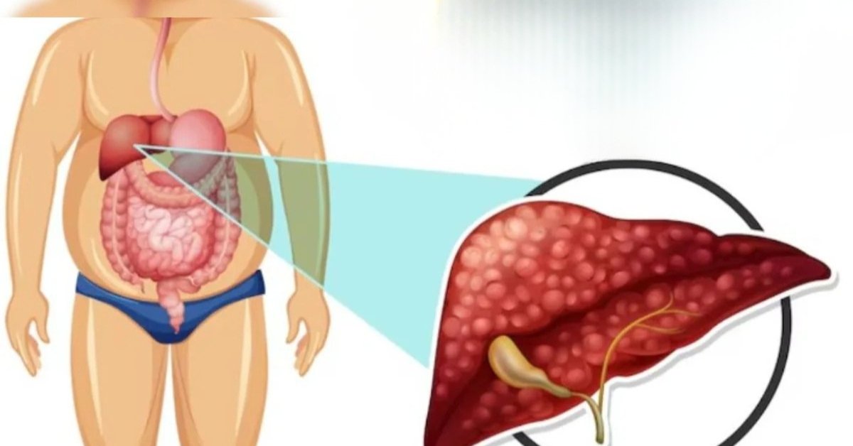 Pre Diabities और Fatty Liver: एक ही वजह से शुरू होती हैं दो बड़ी बीमारियां